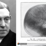 The-Man-Who-Invented-the-Lobotomy